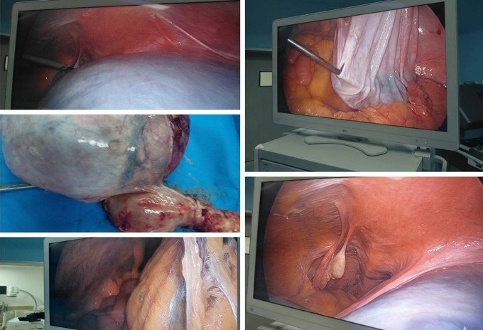 Postmenopausal Ovarian Cyst Treatment in Sector 82, Gurugram