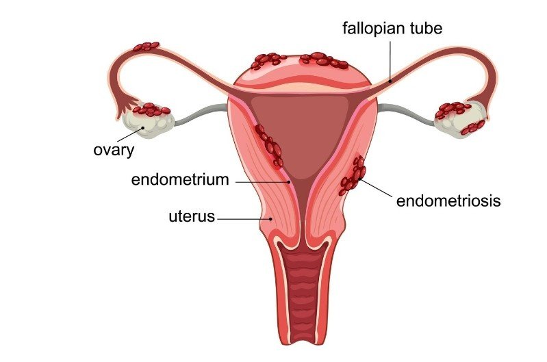 Best Endometriosis Treatment in Gurugram
