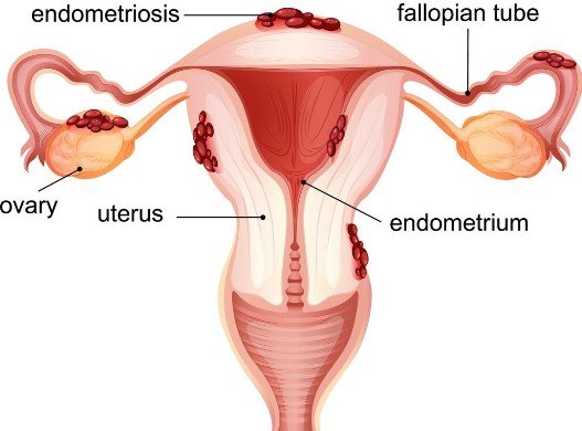 Treatment for Endometriosis in Sector 85 Gurugram